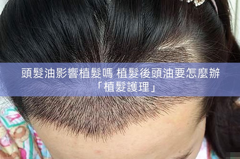 頭髮油影響植髮嗎 植髮後頭油要怎麼辦「植髮護理」 頭髮油影響植髮嗎 植髮後頭油要怎麼辦「植髮護理」