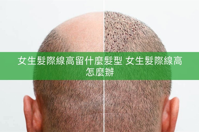 女生髮際線高留什麼髮型 女生髮際線高怎麼辦