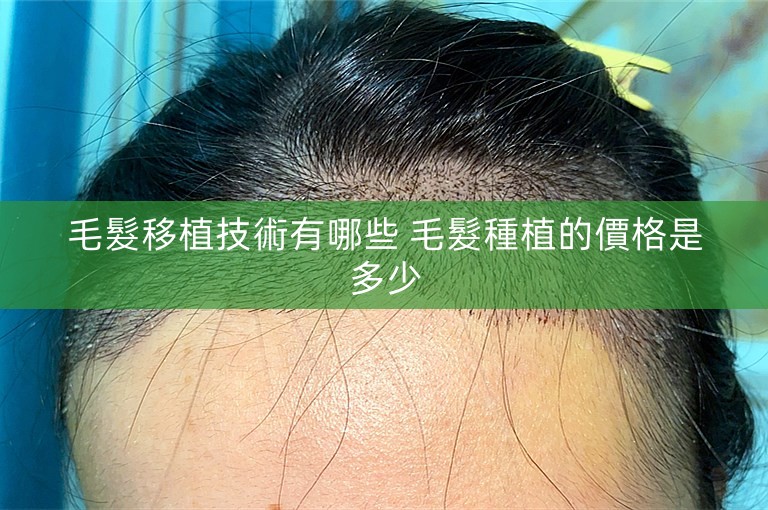 毛髮移植技術有哪些 毛髮種植的價格是多少