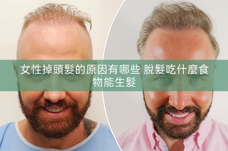 女性掉頭髮的原因有哪些 脫髮吃什麼食物能生髮