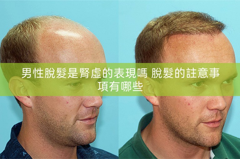 男性脫髮是腎虛的表現嗎 脫髮的註意事項有哪些