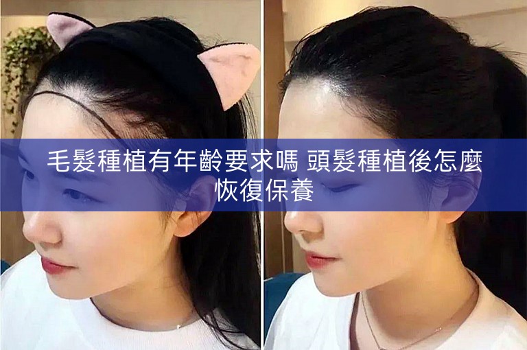 毛髮種植有年齡要求嗎 頭髮種植後怎麼恢復保養