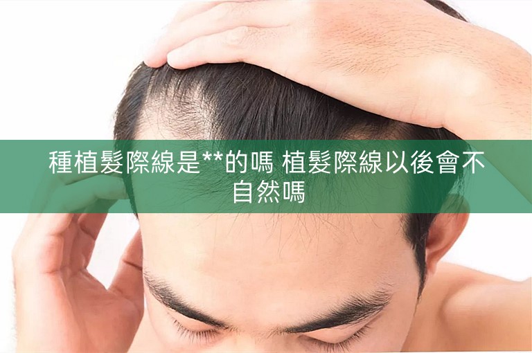 種植髮際線是**的嗎 植髮際線以後會不自然嗎