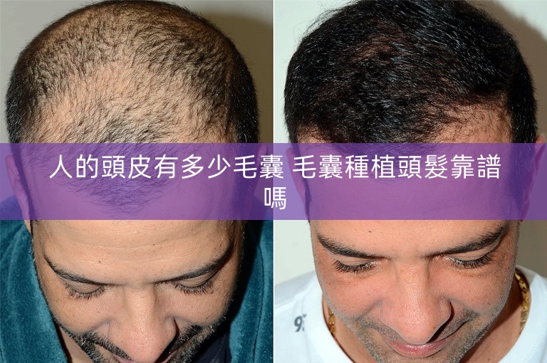 人的頭皮有多少毛囊 毛囊種植頭髮靠譜嗎