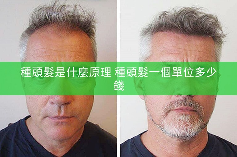 種頭髮是什麼原理 種頭髮一個單位多少錢