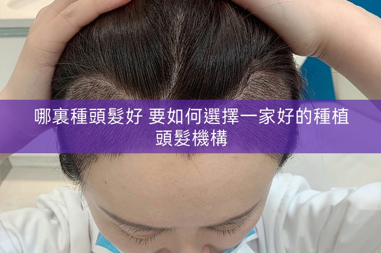 哪裏種頭髮好 要如何選擇一家好的種植頭髮機構 哪裏種頭髮好 要如何選擇一家好的種植頭髮機構