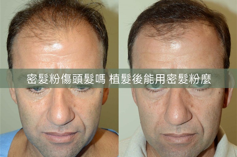 密髮粉傷頭髮嗎 植髮後能用密髮粉麼