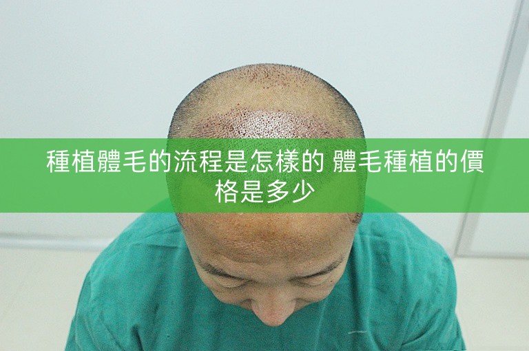 種植體毛的流程是怎樣的 體毛種植的價格是多少