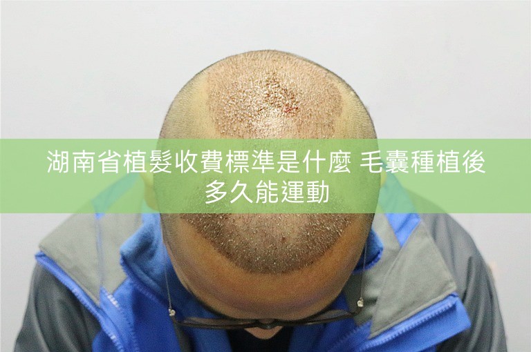 湖南省植髮收費標準是什麼 毛囊種植後多久能運動