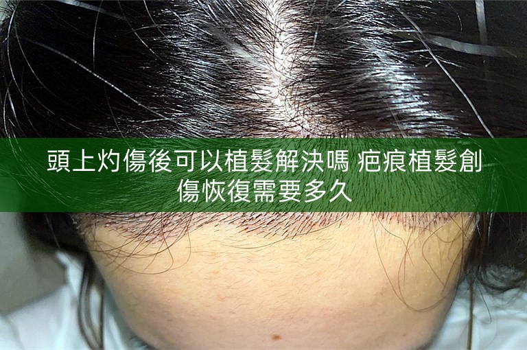 頭上灼傷後可以植髮解決嗎 疤痕植髮創傷恢復需要多久