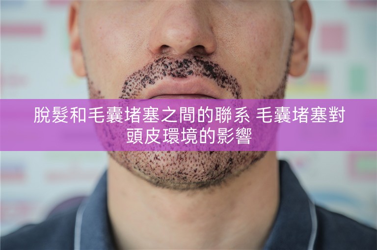 脫髮和毛囊堵塞之間的聯系 毛囊堵塞對頭皮環境的影響