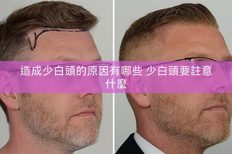 造成少白頭的原因有哪些 少白頭要註意什麼