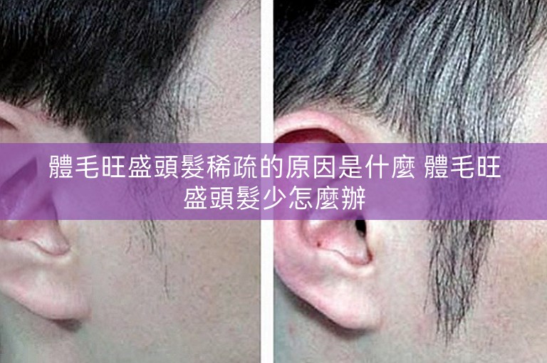 體毛旺盛頭髮稀疏的原因是什麼 體毛旺盛頭髮少怎麼辦