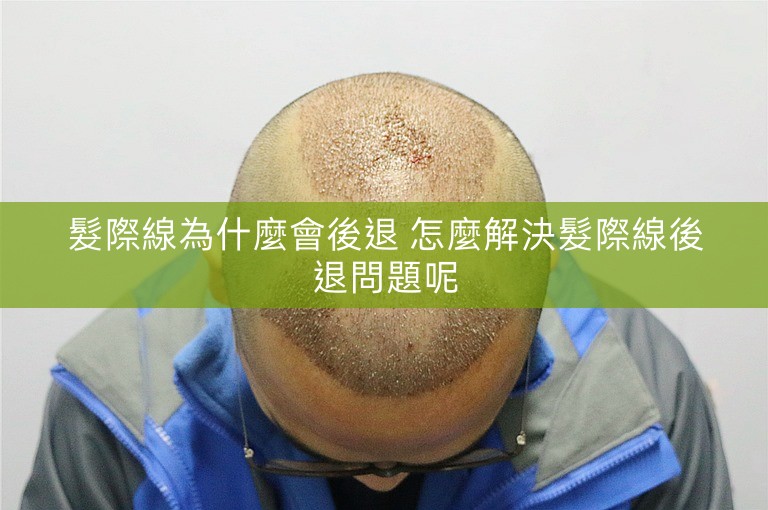 髮際線為什麼會後退 怎麼解決髮際線後退問題呢