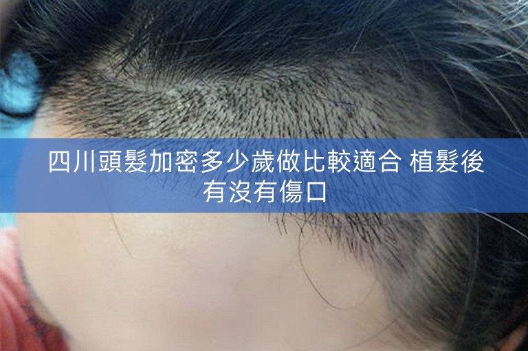 四川頭髮加密多少歲做比較適合 植髮後有沒有傷口