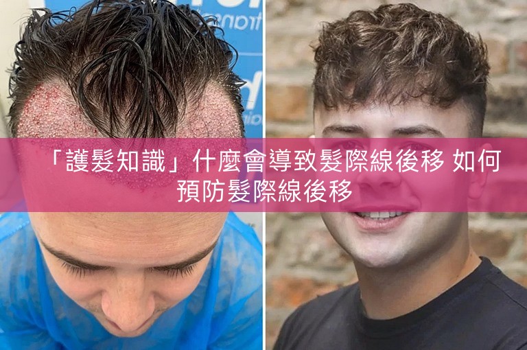 「護髮知識」什麼會導致髮際線後移 如何預防髮際線後移