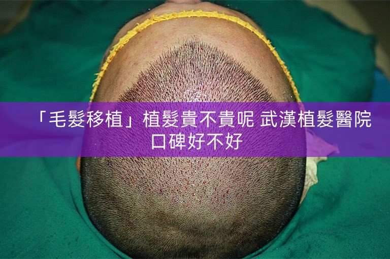 「毛髮移植」植髮貴不貴呢 武漢植髮醫院口碑好不好