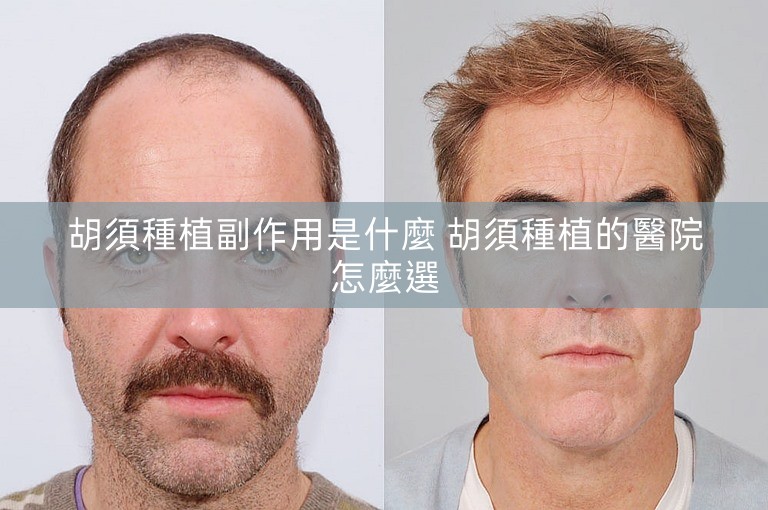 胡須種植副作用是什麼 胡須種植的醫院怎麼選