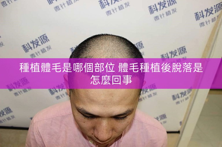種植體毛是哪個部位 體毛種植後脫落是怎麼回事 種植體毛是哪個部位 體毛種植後脫落是怎麼回事