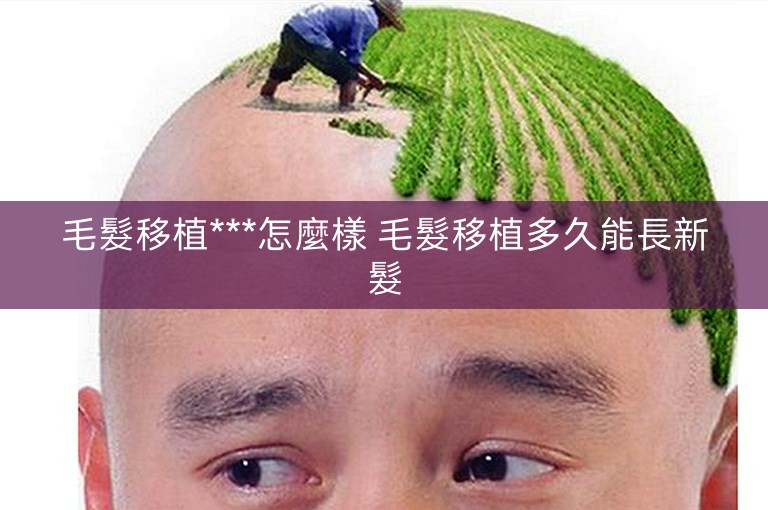 毛髮移植***怎麼樣 毛髮移植多久能長新髮