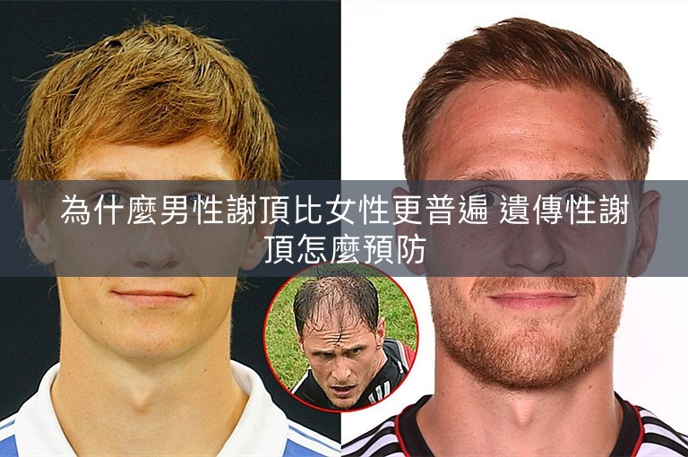 為什麼男性謝頂比女性更普遍 遺傳性謝頂怎麼預防