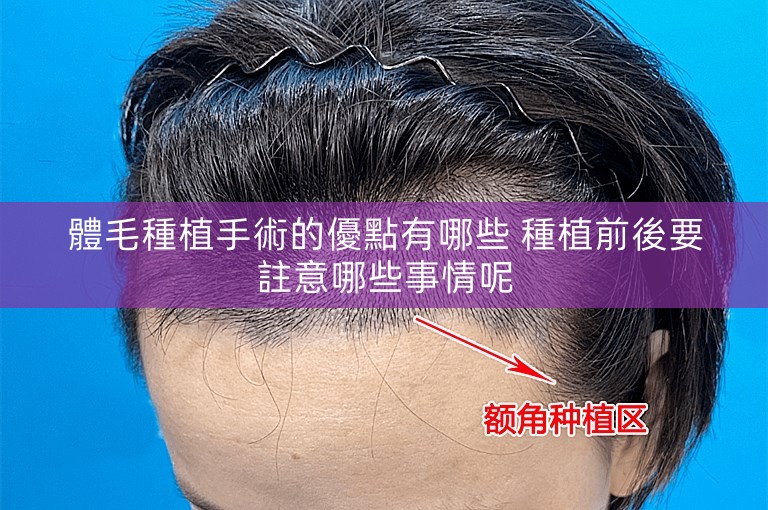 體毛種植手術的優點有哪些 種植前後要註意哪些事情呢