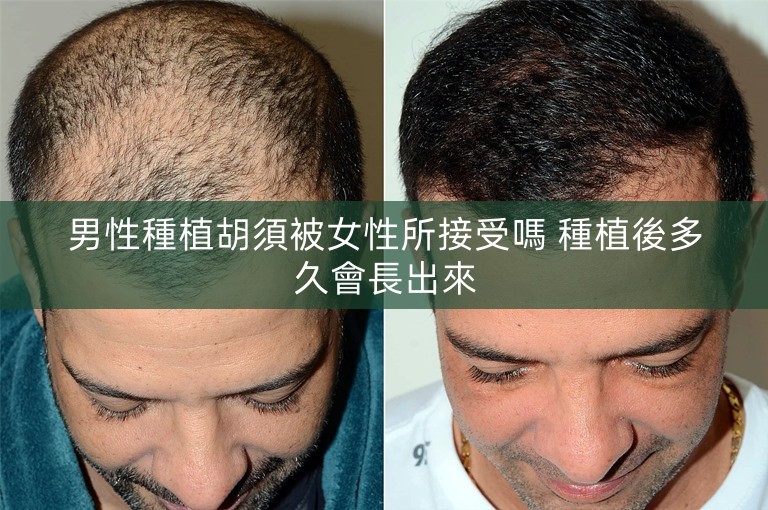 男性種植胡須被女性所接受嗎 種植後多久會長出來 男性種植胡須被女性所接受嗎 種植後多久會長出來
