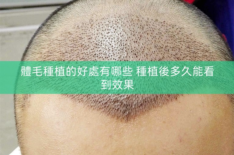 體毛種植的好處有哪些 種植後多久能看到效果 體毛種植的好處有哪些 種植後多久能看到效果