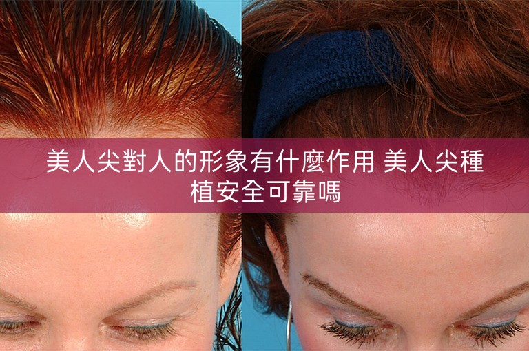 美人尖對人的形象有什麼作用 美人尖種植安全可靠嗎