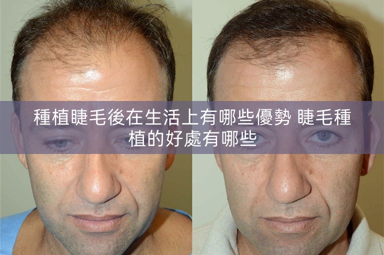 種植睫毛後在生活上有哪些優勢 睫毛種植的好處有哪些