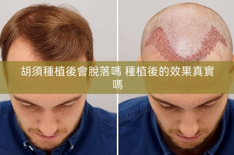 胡須種植後會脫落嗎 種植後的效果真實嗎
