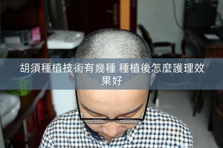 胡須種植技術有幾種 種植後怎麼護理效果好