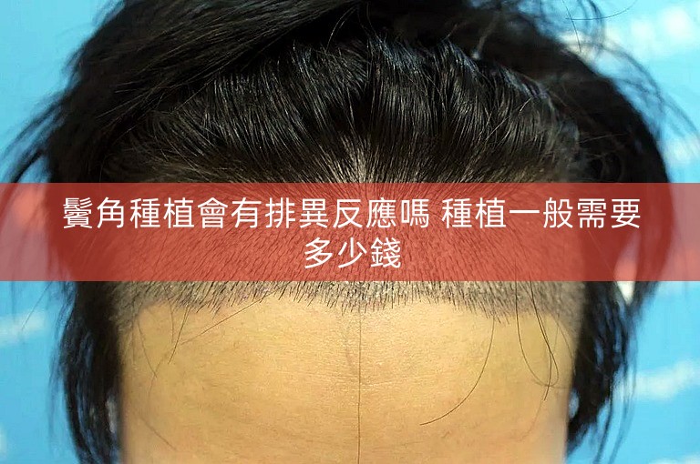 鬢角種植會有排異反應嗎 種植一般需要多少錢