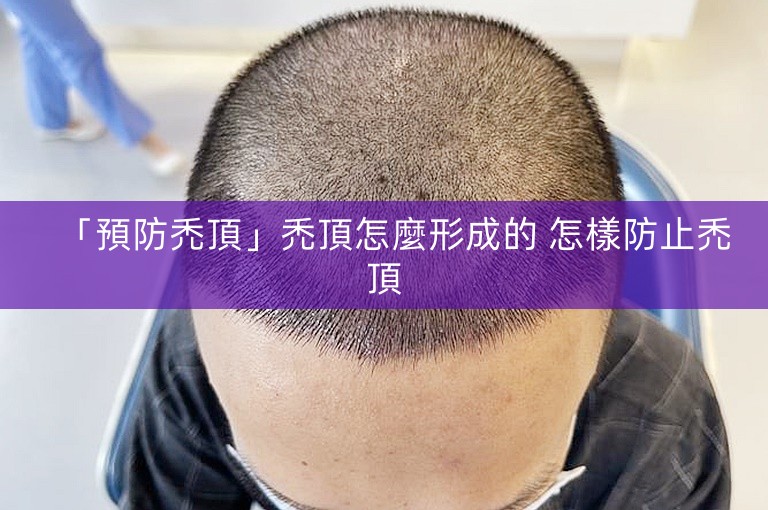 「預防禿頂」禿頂怎麼形成的 怎樣防止禿頂