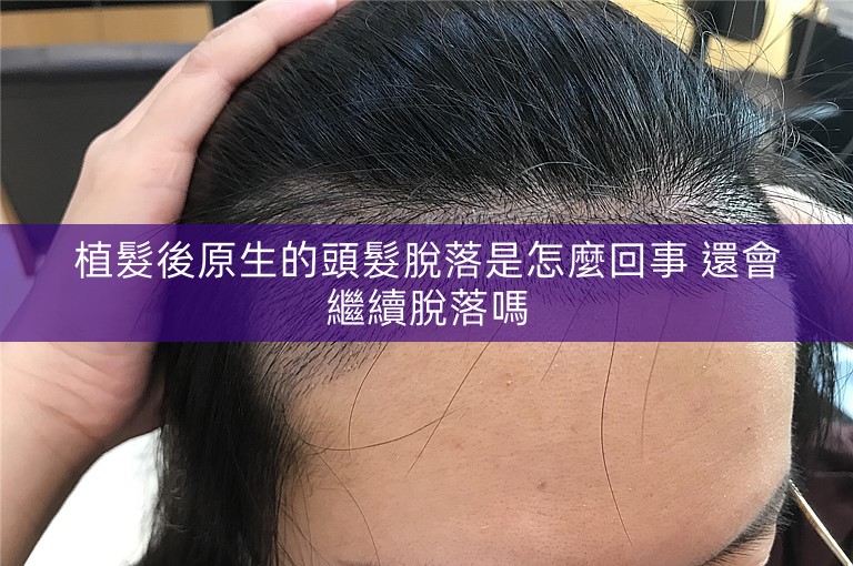 植髮後原生的頭髮脫落是怎麼回事 還會繼續脫落嗎