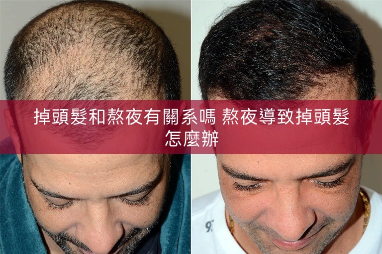 掉頭髮和熬夜有關系嗎 熬夜導致掉頭髮怎麼辦