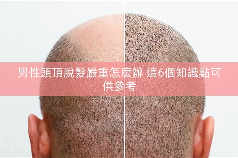 男性頭頂脫髮嚴重怎麼辦 這6個知識點可供參考