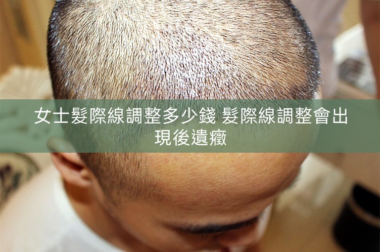 女士髮際線調整多少錢 髮際線調整會出現後遺癥