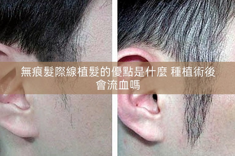 無痕髮際線植髮的優點是什麼 種植術後會流血嗎