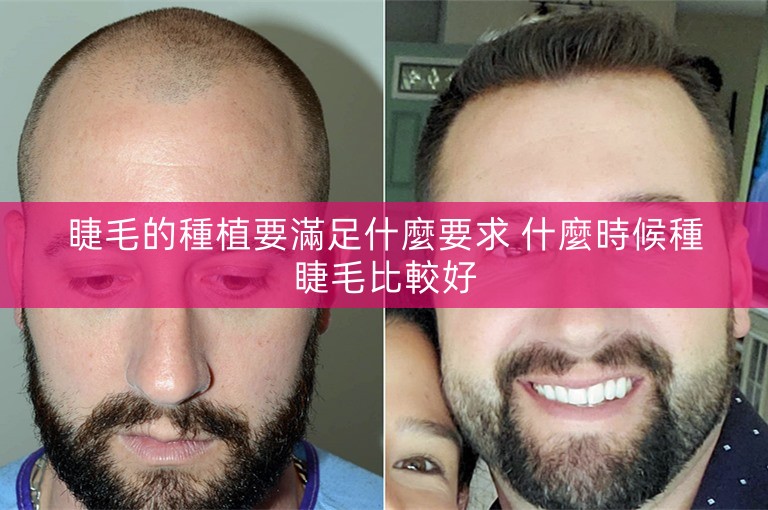 睫毛的種植要滿足什麼要求 什麼時候種睫毛比較好