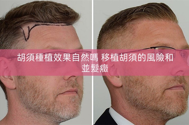 胡須種植效果自然嗎 移植胡須的風險和並髮癥