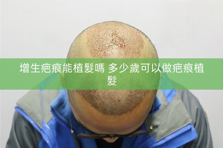增生疤痕能植髮嗎 多少歲可以做疤痕植髮