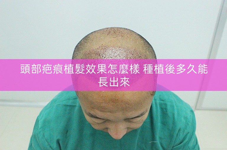 頭部疤痕植髮效果怎麼樣 種植後多久能長出來