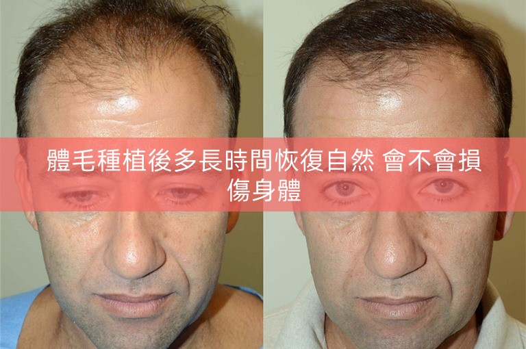 體毛種植後多長時間恢復自然 會不會損傷身體