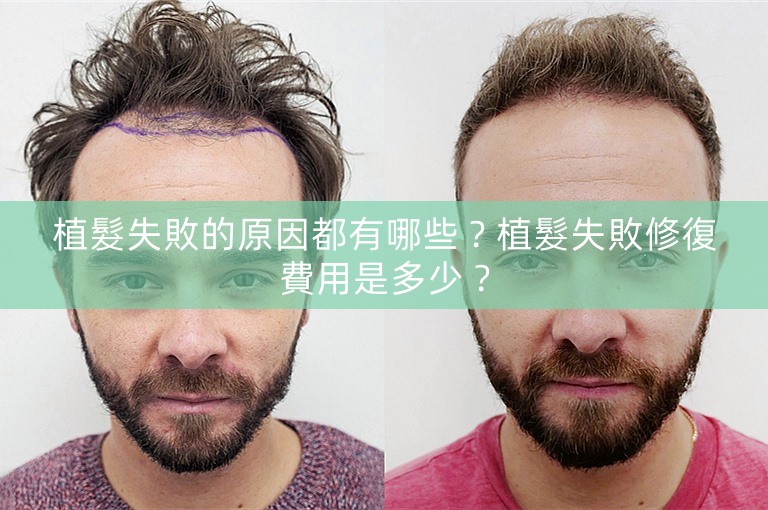 植髮失敗的原因都有哪些？植髮失敗修復費用是多少？