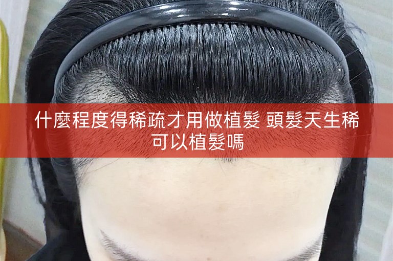 什麼程度得稀疏才用做植髮 頭髮天生稀可以植髮嗎