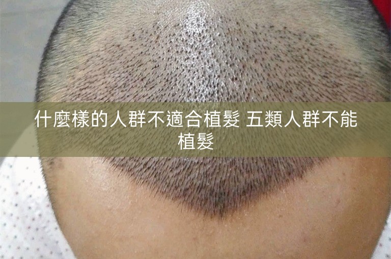 什麼樣的人群不適合植髮 五類人群不能植髮