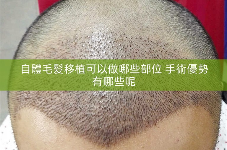 自體毛髮移植可以做哪些部位 手術優勢有哪些呢 自體毛髮移植可以做哪些部位 手術優勢有哪些呢