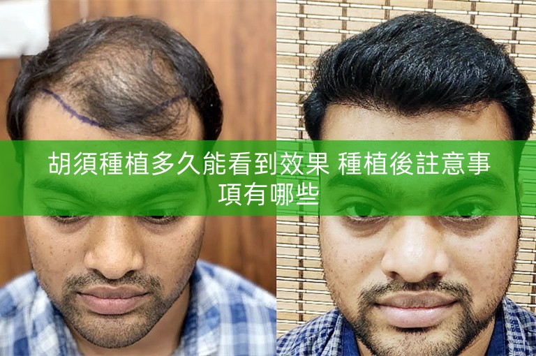 胡須種植多久能看到效果 種植後註意事項有哪些 胡須種植多久能看到效果 種植後註意事項有哪些