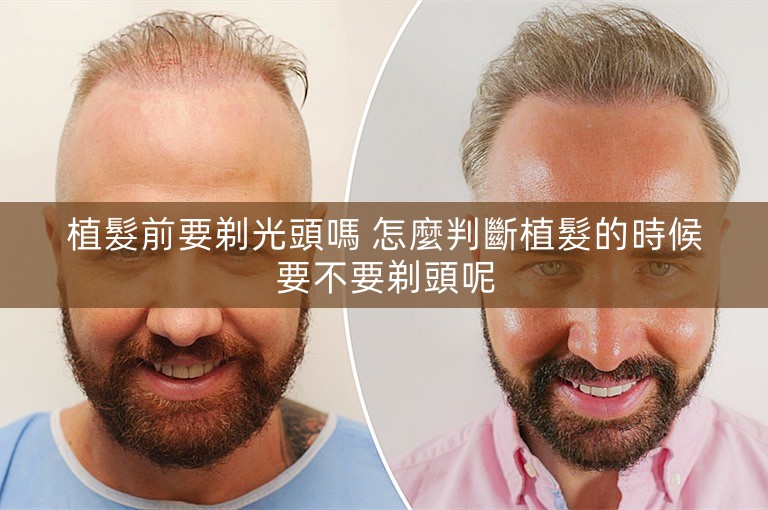 植髮前要剃光頭嗎 怎麼判斷植髮的時候要不要剃頭呢 植髮前要剃光頭嗎 怎麼判斷植髮的時候要不要剃頭呢